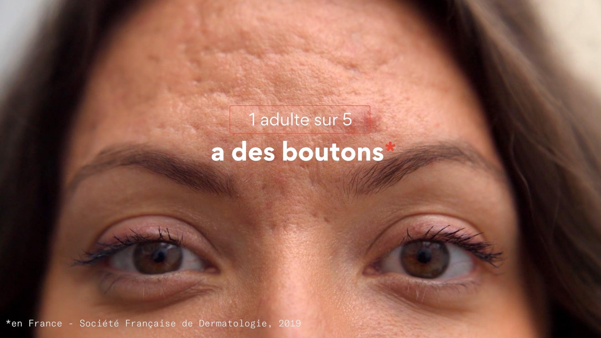 Acne Awareness Month