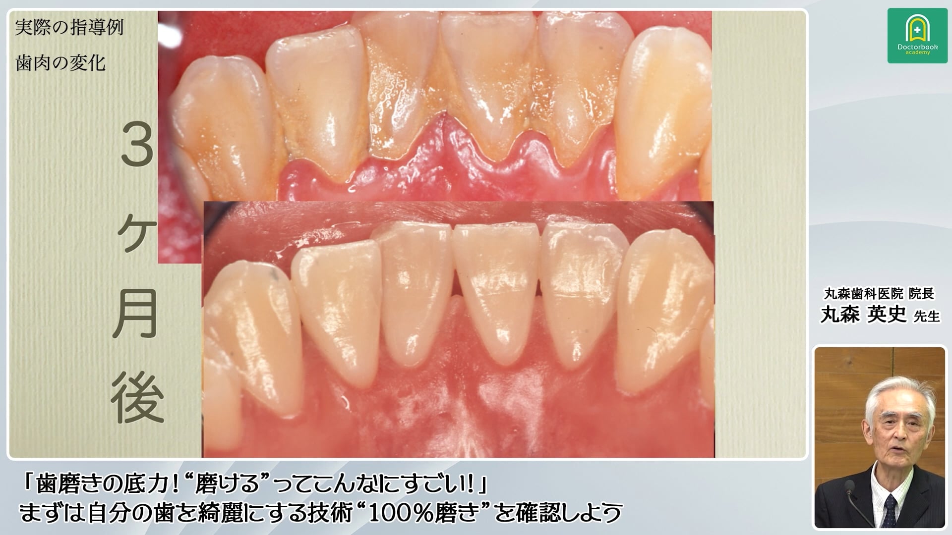 『毛先磨き』のポイントと指導方法│丸森英史先生