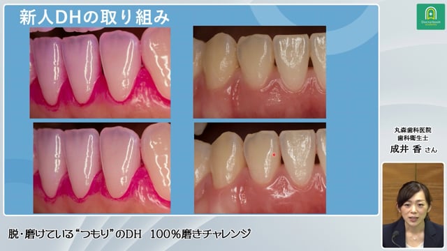 脱・磨けている“つもり”のDH 100%磨きチャレンジ│成井香さん