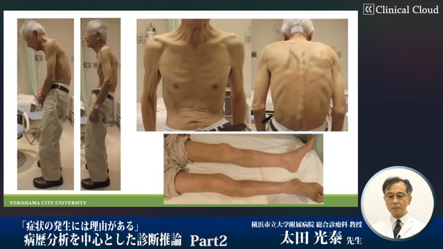 「症状の発生には理由がある」病歴分析を中心とした診断推論 Part2 Clinical Cloud