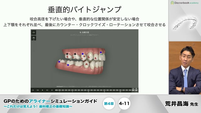 GPのためのアライナーシミュレーションガイド 〜これだけは覚えよう 