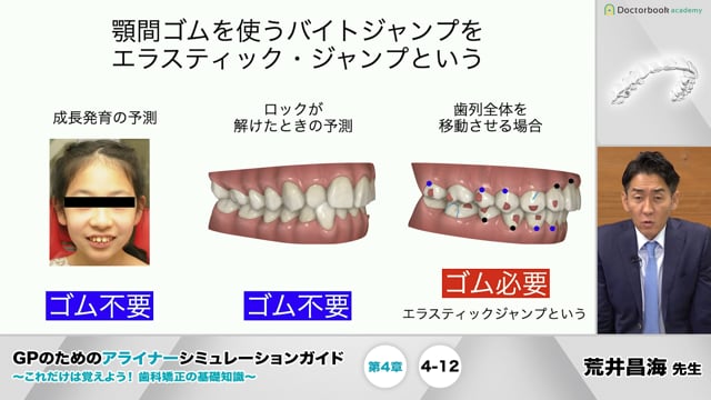 第4章 移動量と移動限界│GPのためのアライナーシミュレーションガイド 