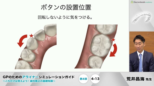 第4章 移動量と移動限界│GPのためのアライナーシミュレーションガイド