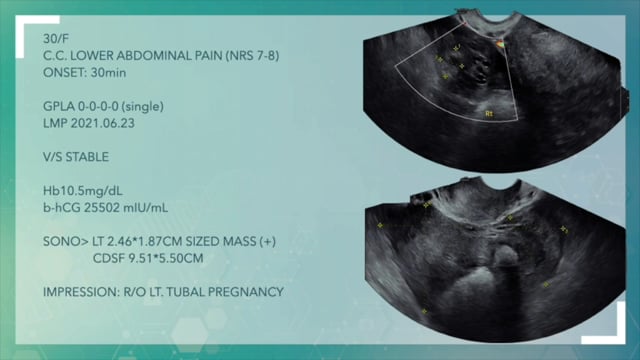 자궁외임신 수술 (Single-port laparoscopic salpingectomy)