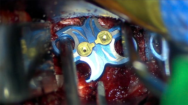 Anterior Discectomy and Fusion for a Type II Traumatic Spondylolisthesis of the Axis (Hangman’s Fracture