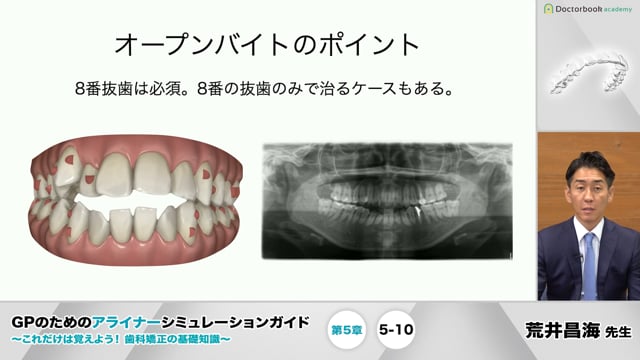 第5章 症例ごとの治療計画│GPのためのアライナーシミュレーション 