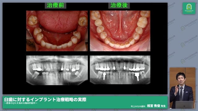 臼歯に対するインプラント治療戦略の実際