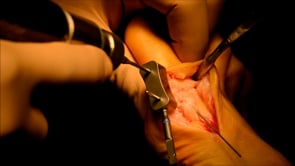 First Metatarsophalangeal Joint Arthrodesis using Arcad Nitinol Compression Staples