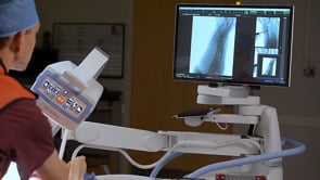 Chevron Osteotomy with PECA System