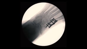First Metatarsal-Cuneiform Arthrodesis using Airlock® Lapidus Plate and Nexis Compression Screw