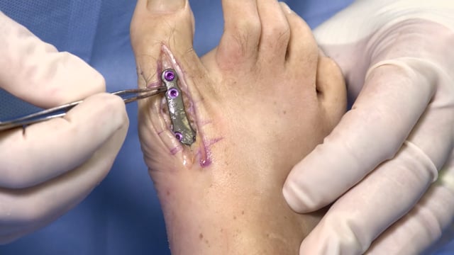 First Metatarsophalangeal Joint Fusion with Airlock® MTP Fusion Plate and Nexis® Compression Screw