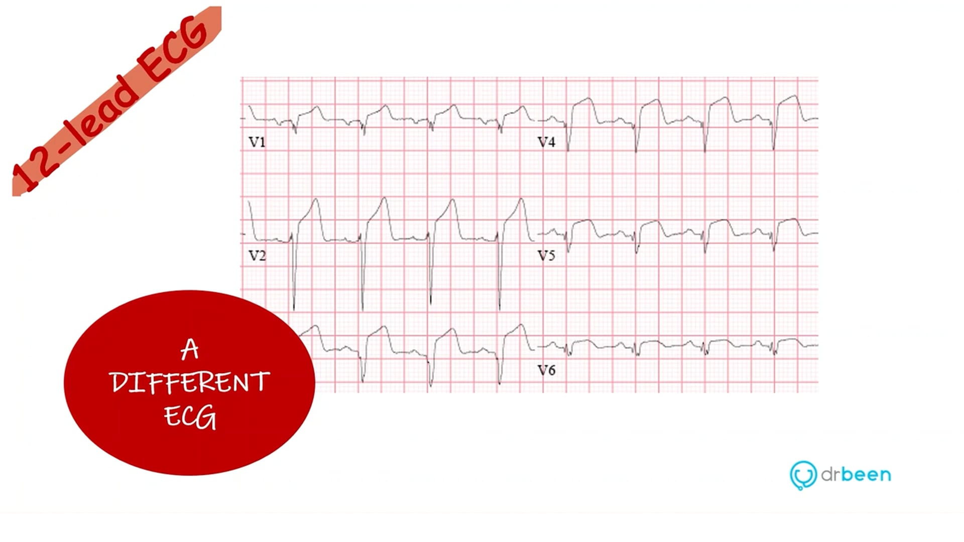 STEMI Part 2 (Dr. Bhatti)