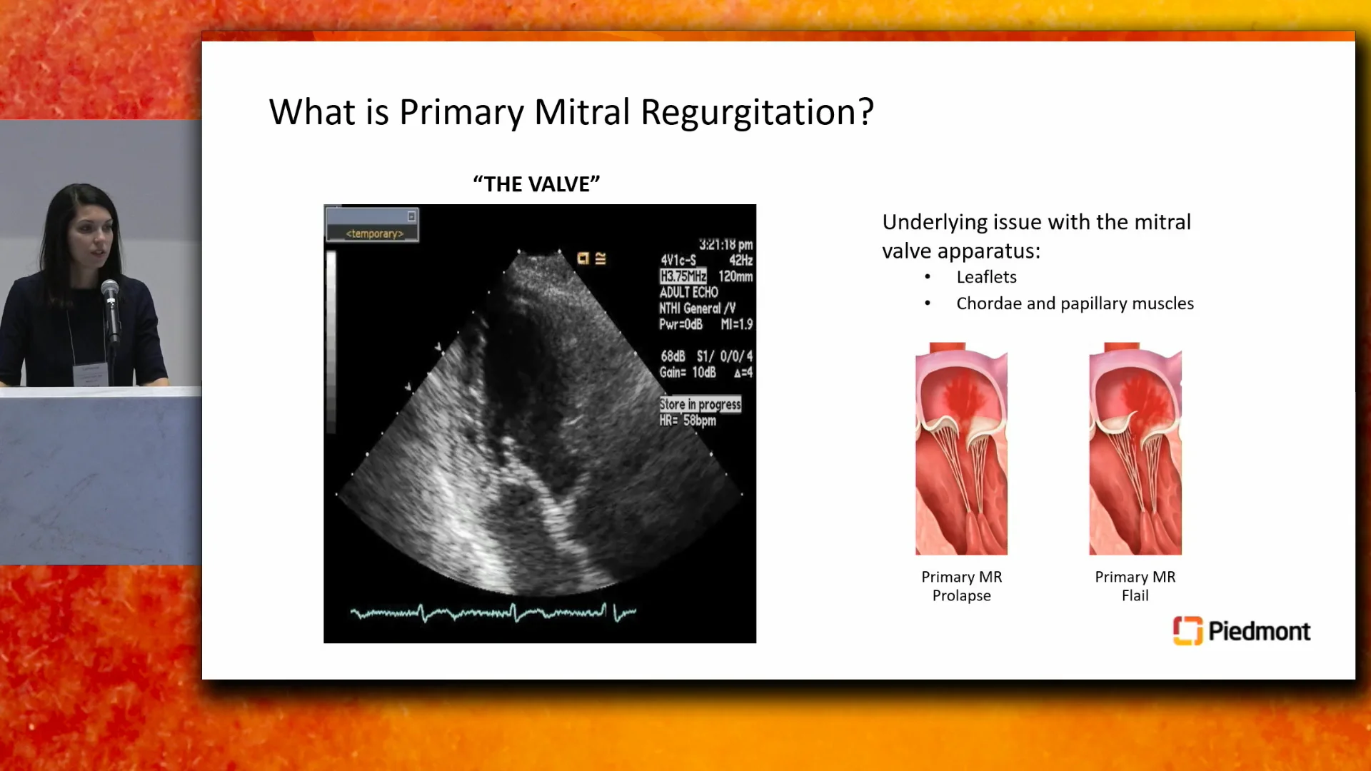 Marcus Heart Valve Center - Secondary Mitral Regurgitation Role of ...