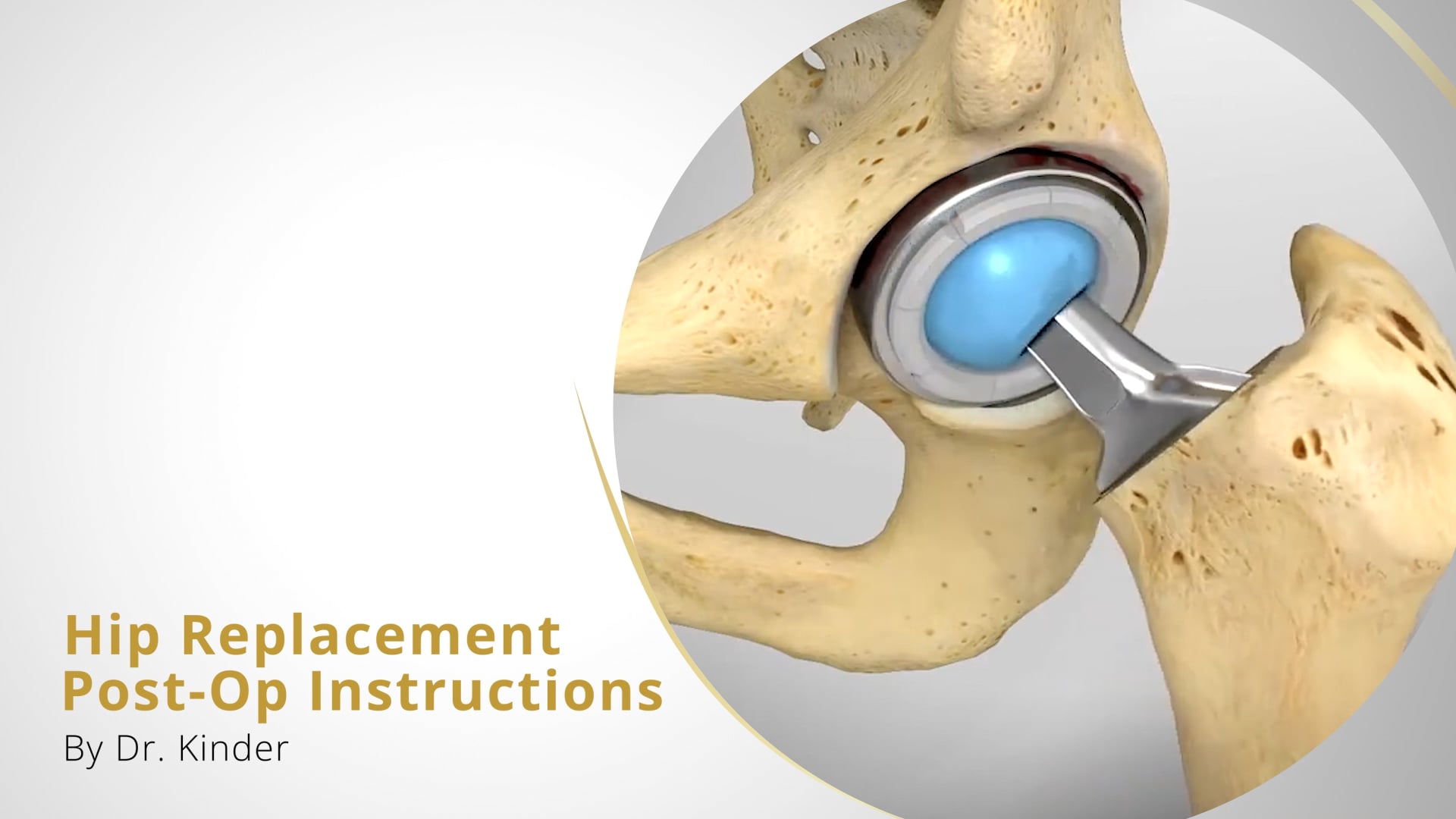 Hip Replacement Post-Op Instructions - Dr. Kinder