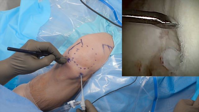 Wide-Awake Cartilage Biopsy for MACI of the Knee using NanoScope Needle Arthroscopy