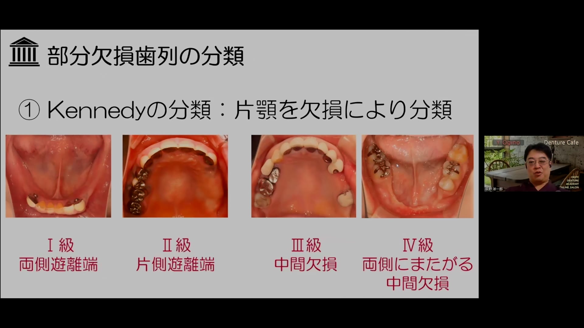 Kennedyの分類で義歯設計を考える│荻野洋一郎先生 #1