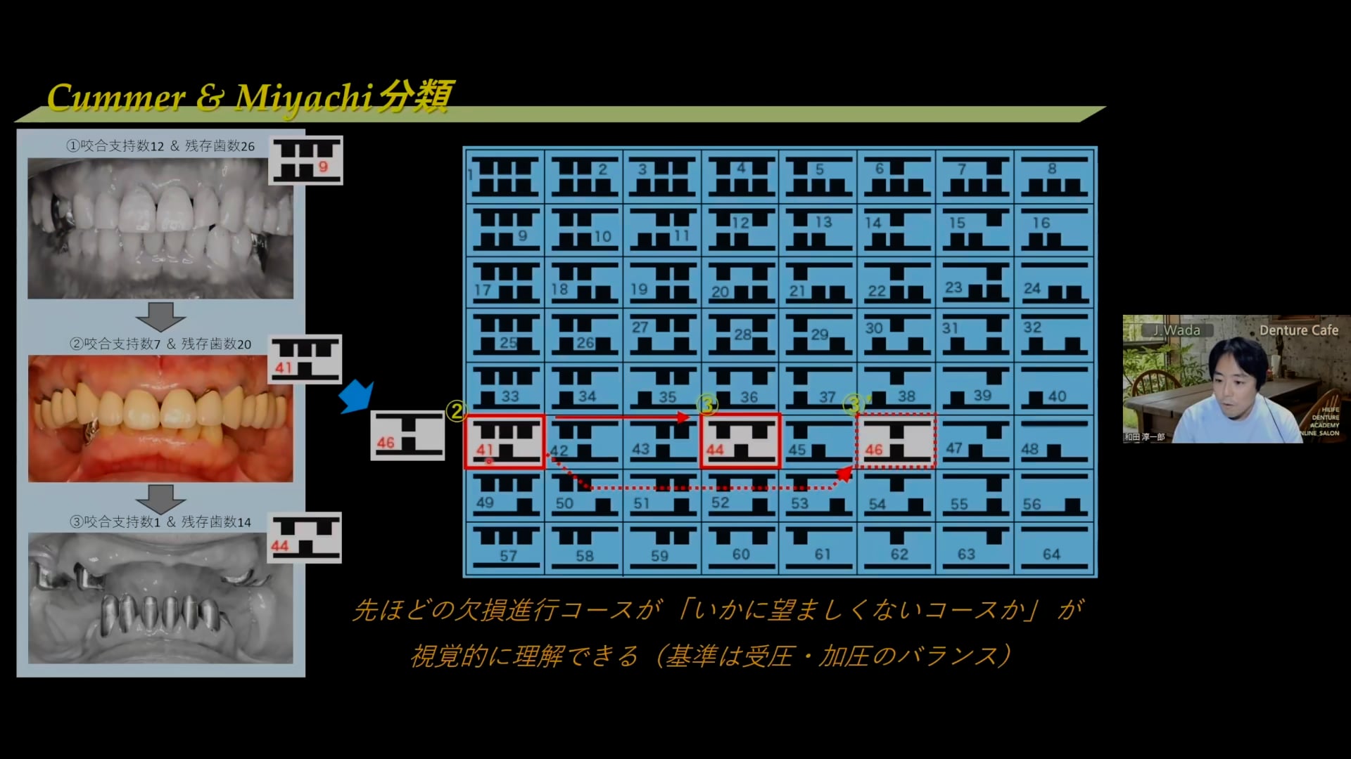 Cummer分類&咬合三角│和田淳一郎先生 #2