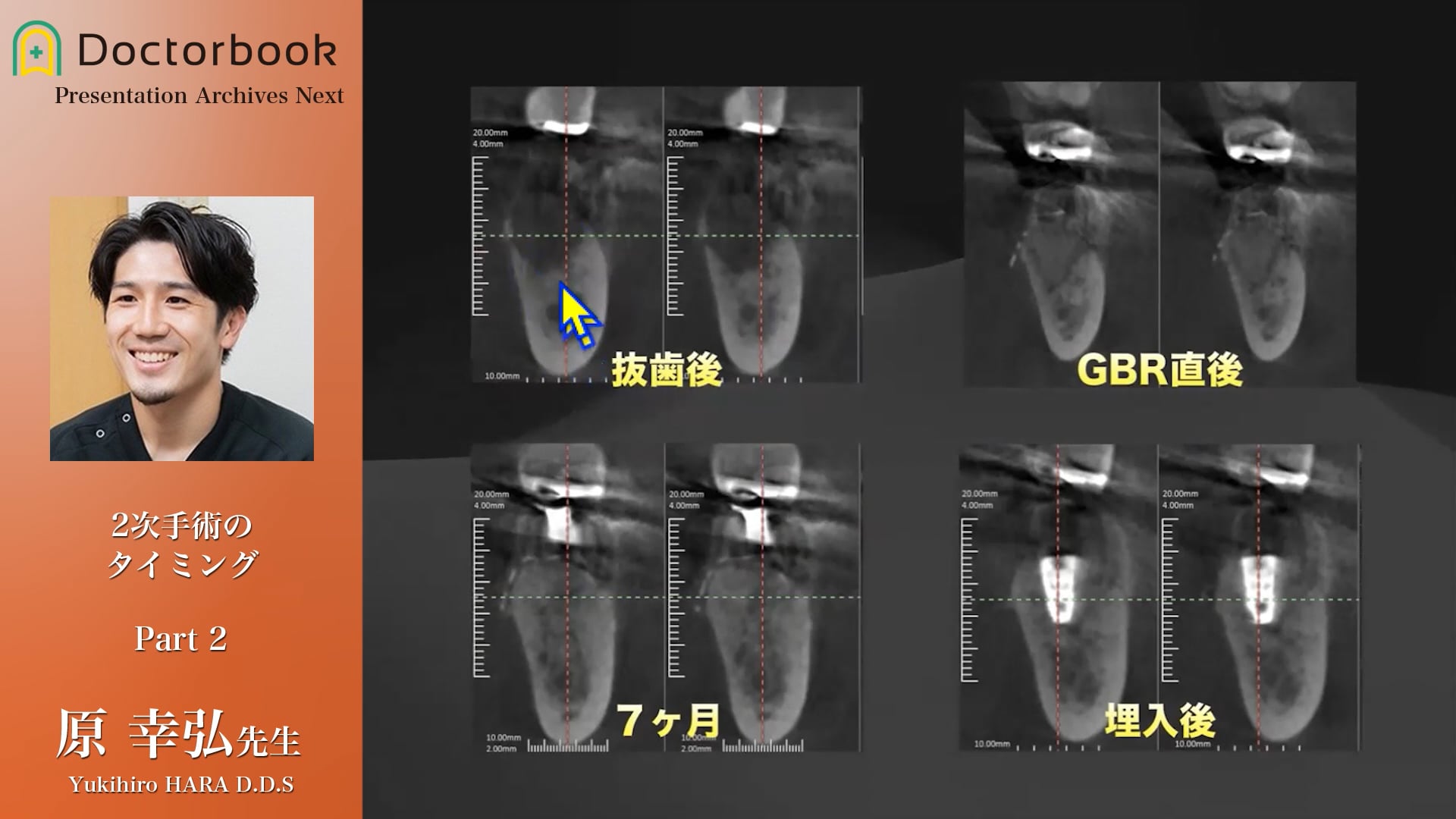 骨造成後のBiology│2次手術に移行するタイミング