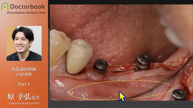 治療計画・外科手技のポイント│角化歯肉移植の必要性