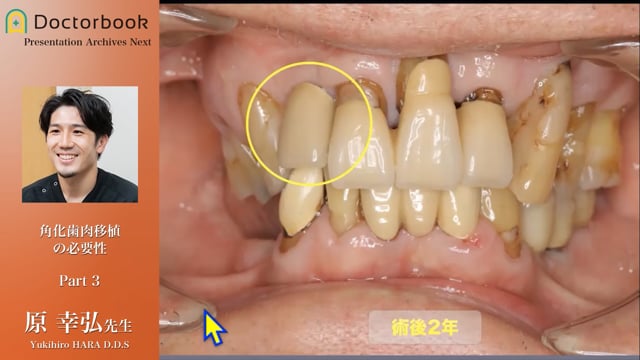 角化歯肉とインプラント周囲炎の関連性│角化歯肉移植の必要性