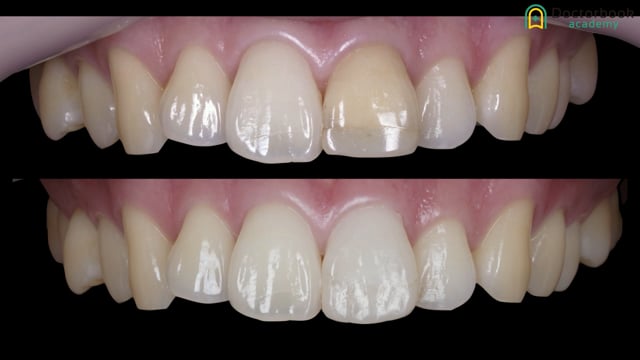 #1 Direct Restoration for a Maxillary Central Incisor 内藤広太郎先生