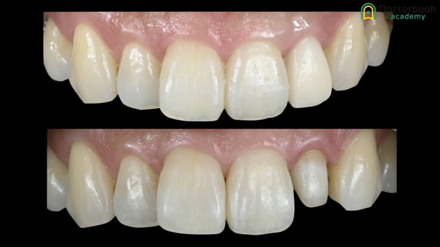 #2 Lateral Incisor restoration with Comprehensive abutment Procedure 中尾伸先生