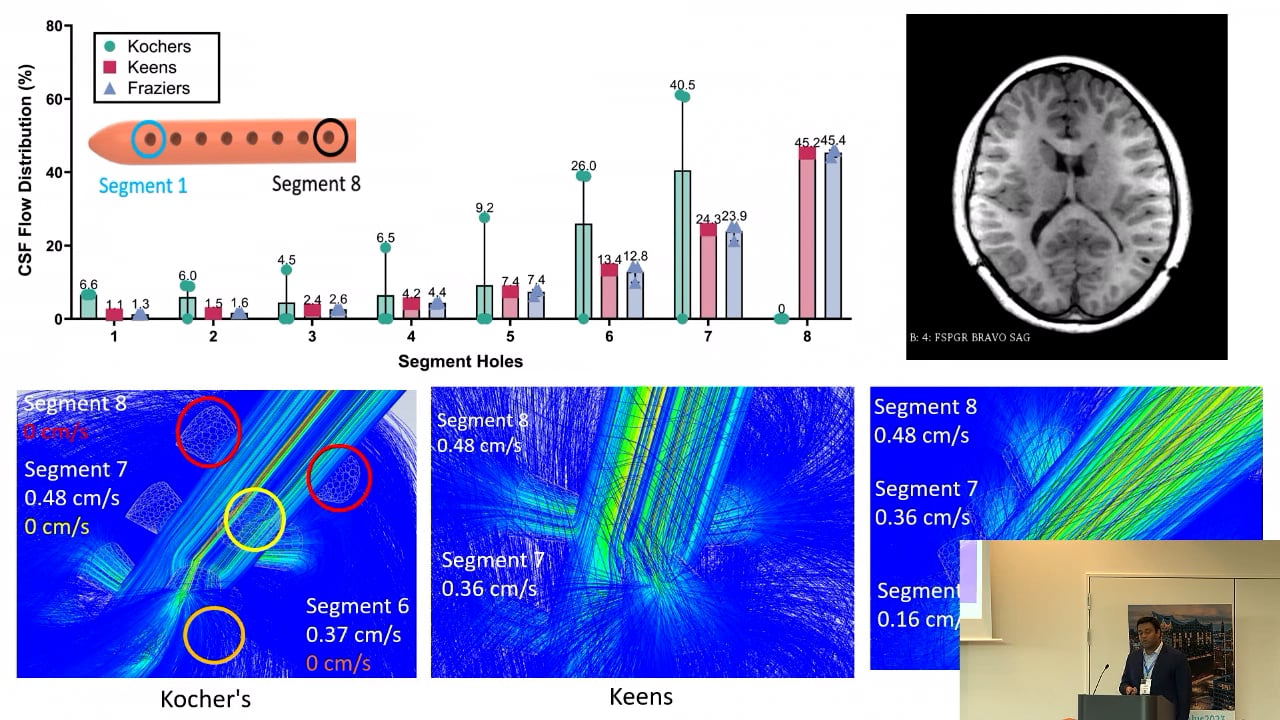 S16. Cristopher Roberts - Influence of ventricular size and surgical approach on flow distribution in ventricular catheters