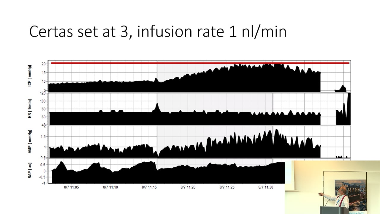 S16. Marek Czosnyka - Shunt testing in vivo, Performance of Certas Valve integrated with SiphonGuard