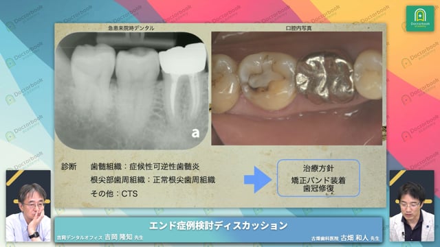 右下第二大臼歯 CTSに歯髄保存した症例│歯髄保存可能な歯と抜髄の判断基準