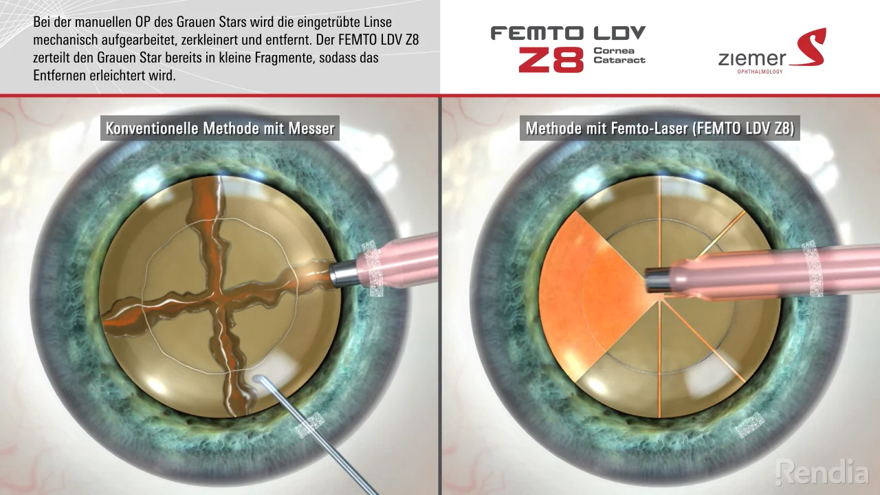Katarakt-OP mit dem FEMTO LDV Z8  Ziemer-Group