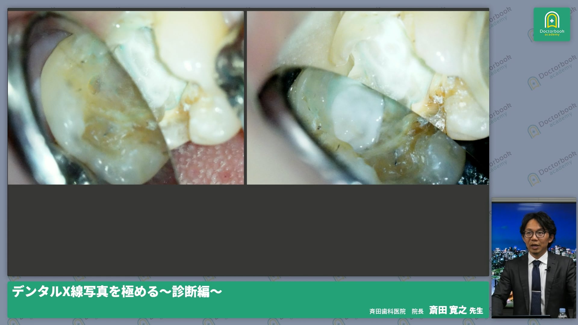 デンタルX線の着眼点│骨欠損の形態・歯周炎・動揺歯・急性炎症とエンドペリオ病変・根尖病変・セメント質剥離・歯根破折