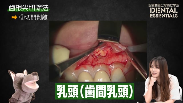 Step2：切開剥離│Dental Essentials｜診療動画と写真で学ぶ vol.1 歯根尖切除術