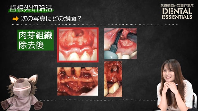 Step3：歯槽骨の切削と肉芽組織の掻爬│Dental Essentials｜診療動画と写真で学ぶ vol.1 歯根尖切除術