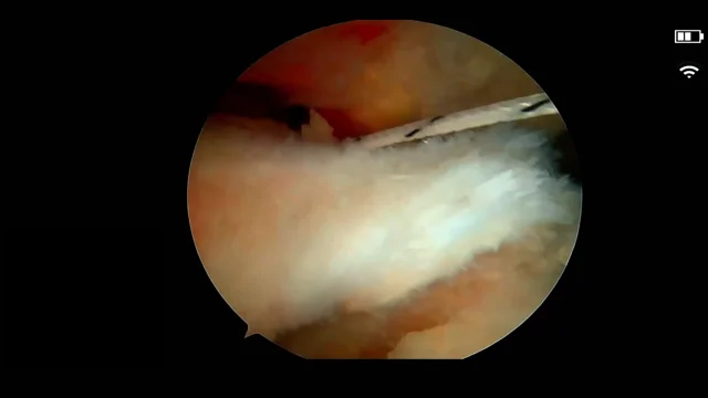 Rotator Cuff Repair: ArthroFree