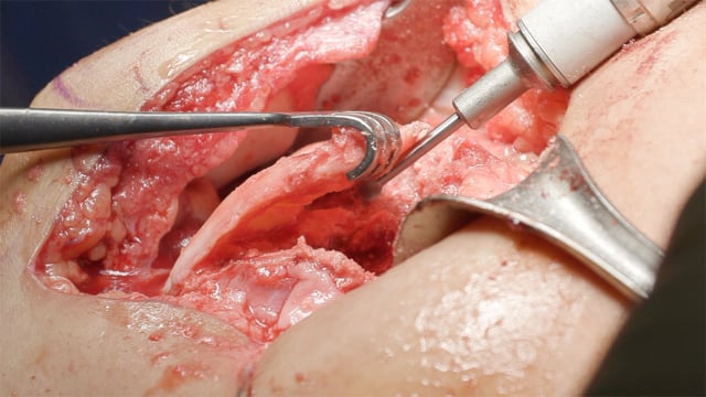 Trochleoplasty with Combined Soft Tissue Reconstruction for Patellar Instability