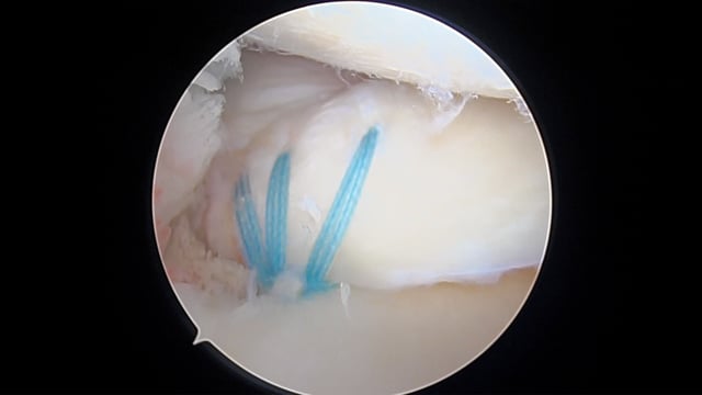 Meniscal Root Repair with Centralization Stitch