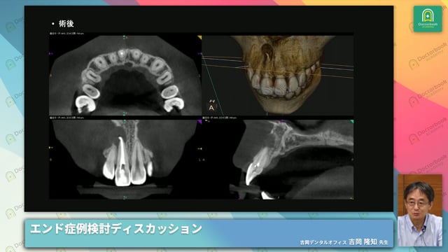 前歯部外傷歯に対するエンド治療症例