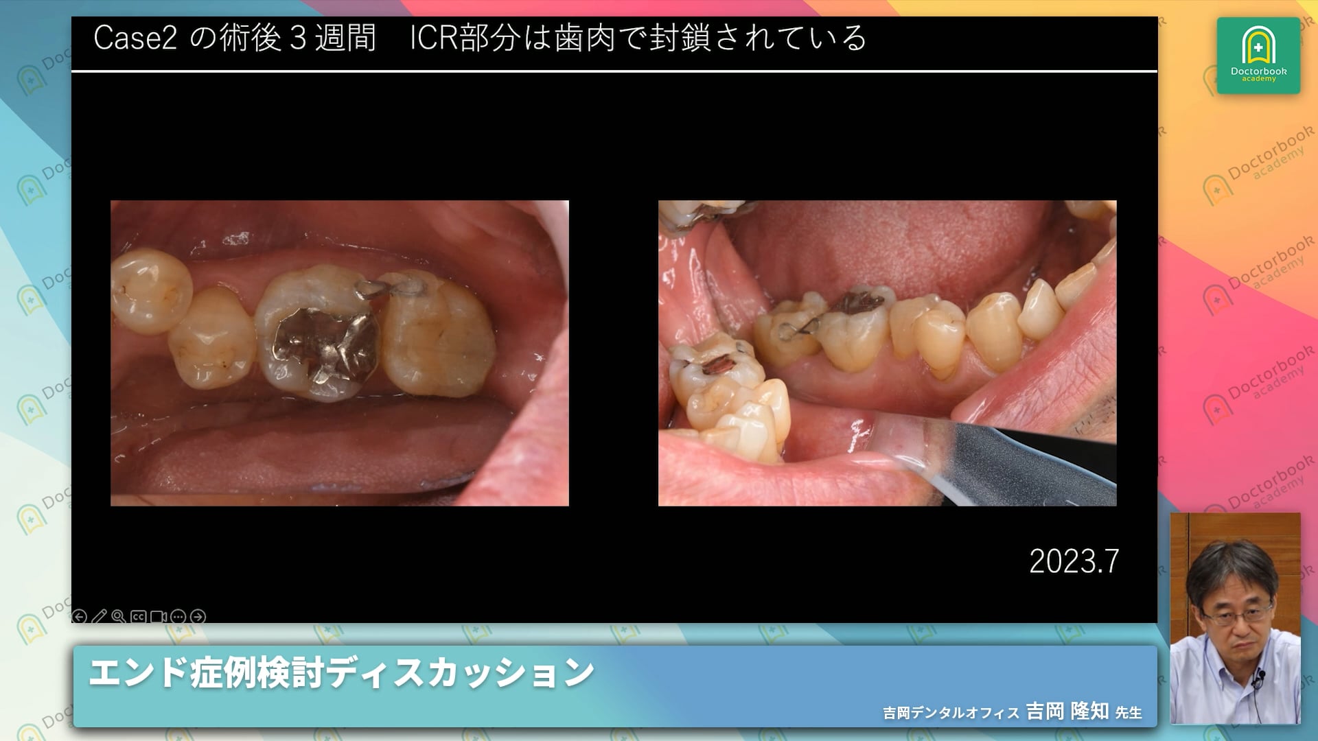 歯頸部外部吸収に対する治療症例 / 外部吸収に対する意図的再植症例