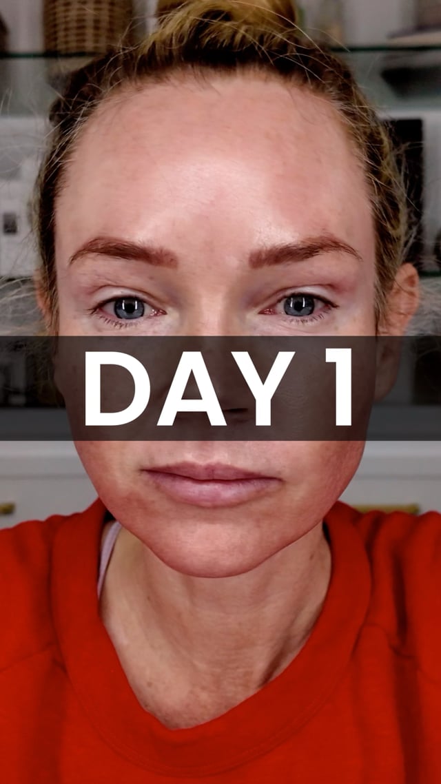 25% TCA Peel: Day 1 video