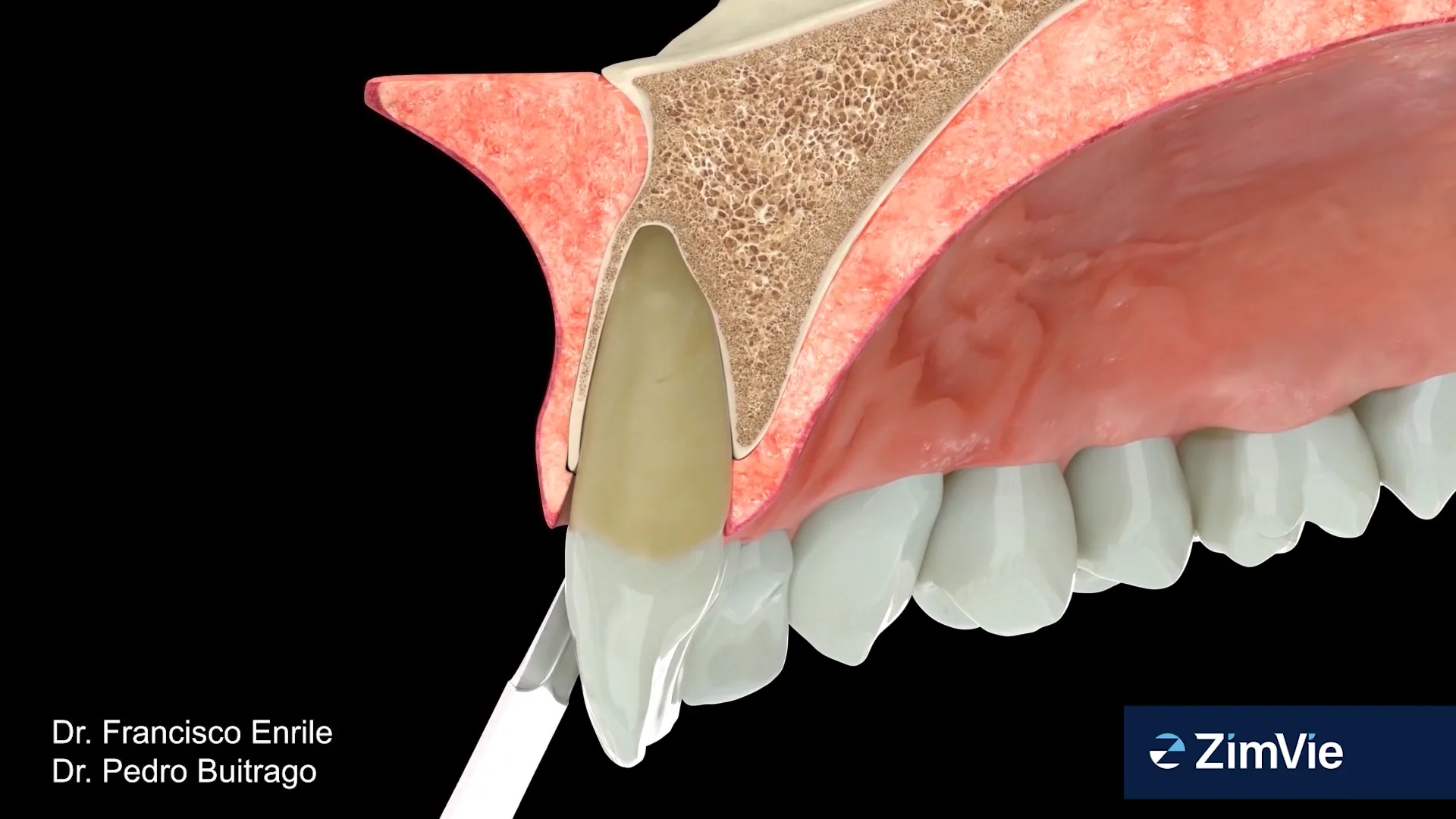 インプラントセラピー IMPLANT THERAPY シエン社 | <増補新版>インプラントセラピー