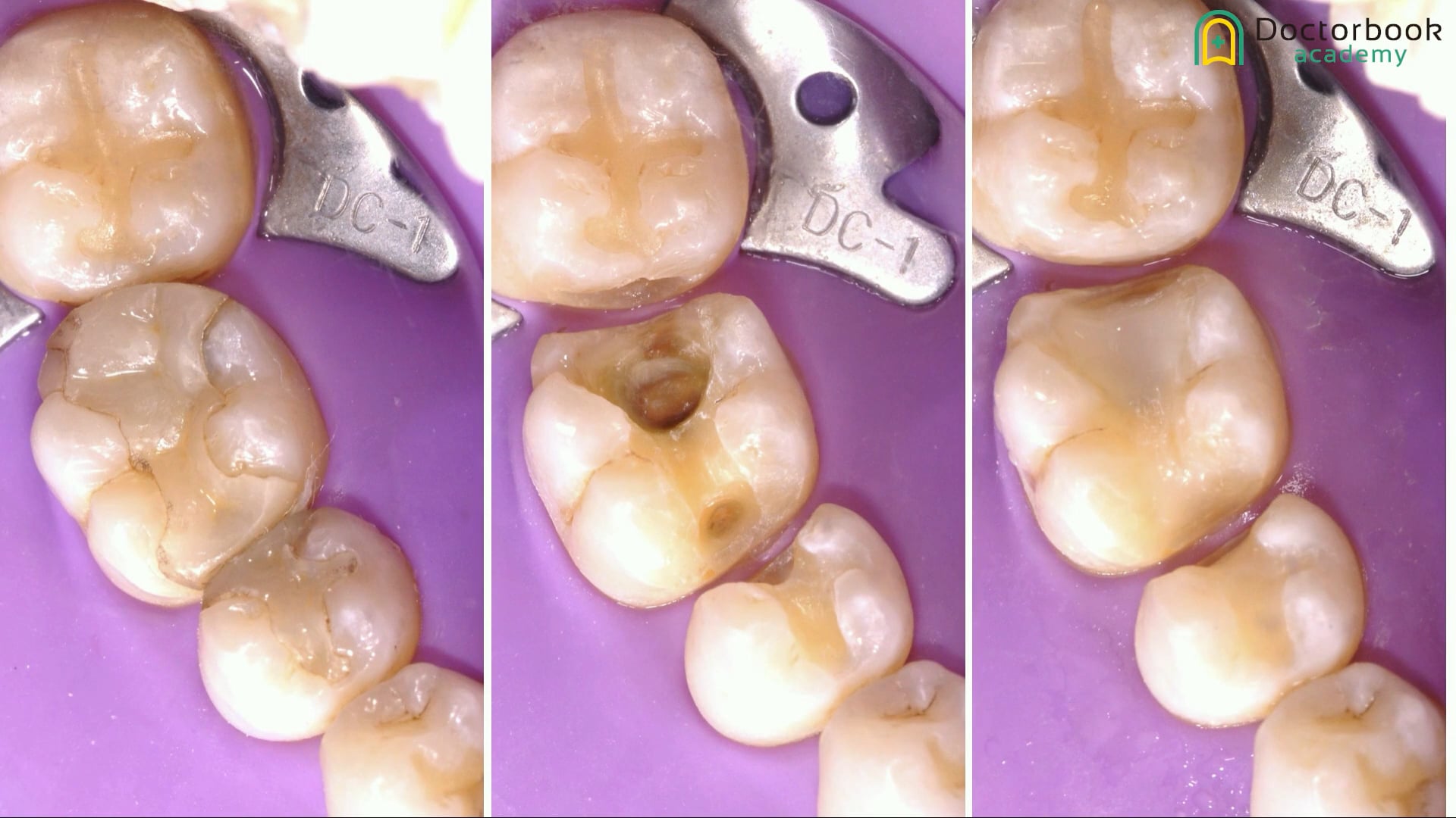 #5 Aim at Longevity of Ceramic restorations 土屋紘司先生