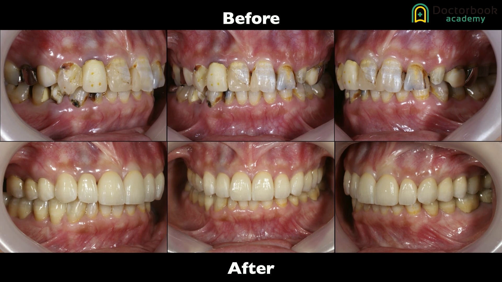 #4 Occlusal reconstruction  using Maxillo Facial Analysis 宇野勇樹先生