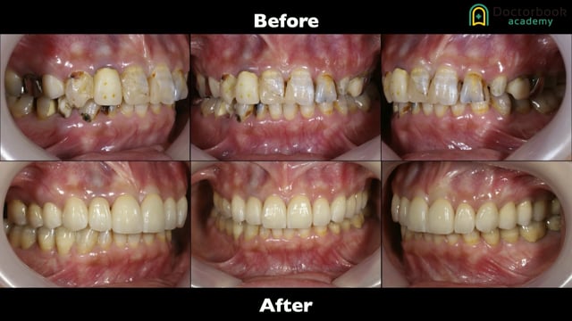 #4 Occlusal reconstruction  using Maxillo Facial Analysis 宇野勇樹先生