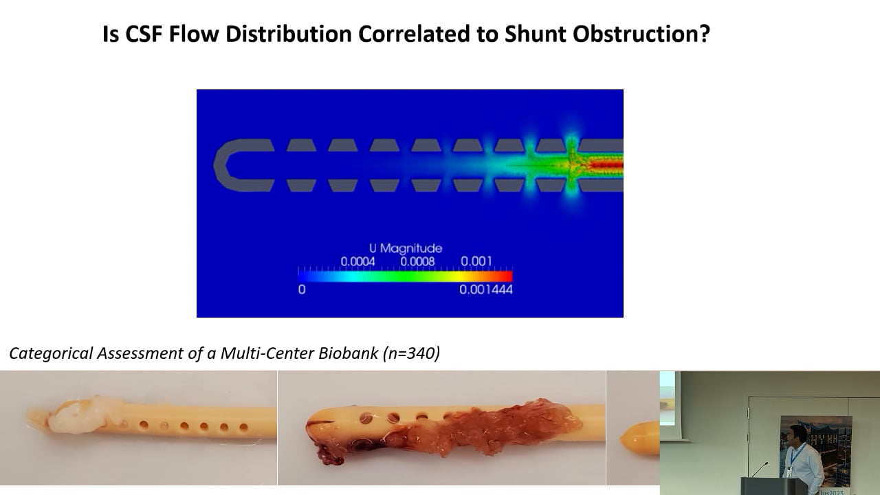 S31. Christopher Roberts - Assessing the relationship between ventricular catheter obstruction and flow using computational flui