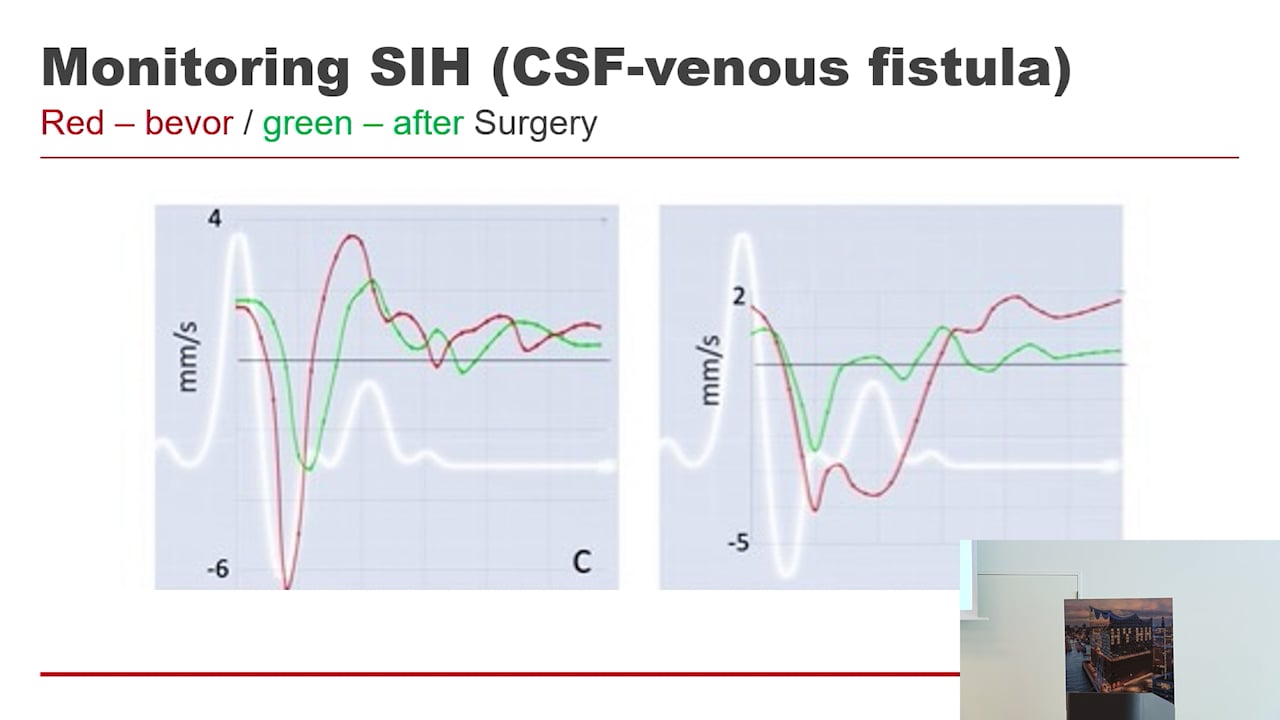 S32. Mark Luciano - Bone Regrowth After Burr Hole Craniostomy, Establishing natural history and implications for post-operative