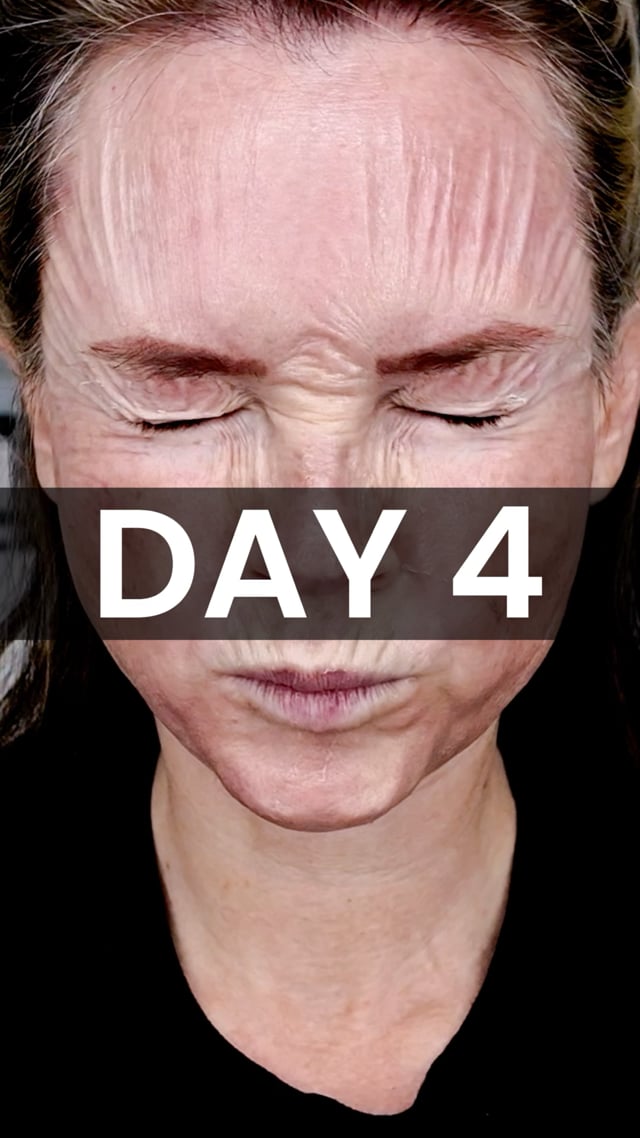25% TCA Peel: Day 4 video