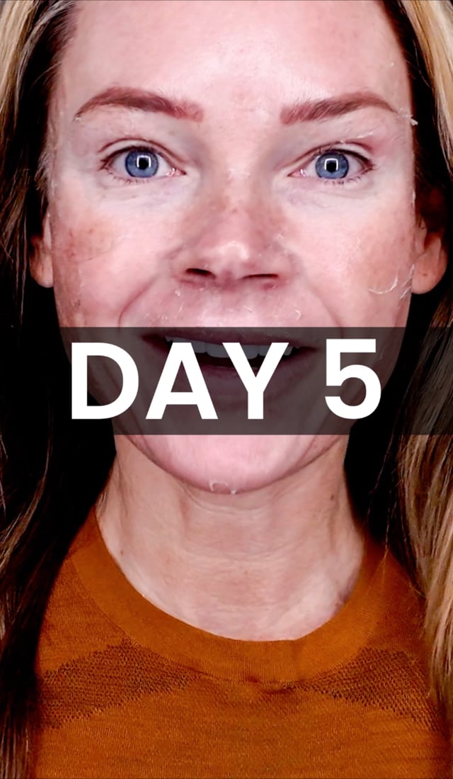 25% TCA Peel: Day 5 video