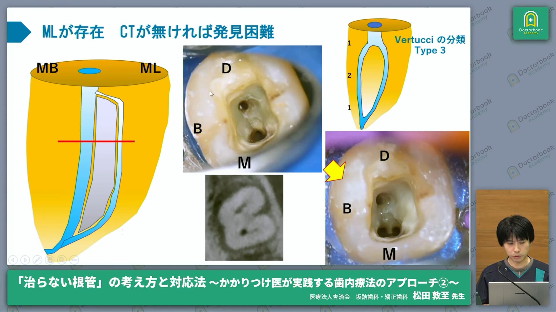 樋状根症例