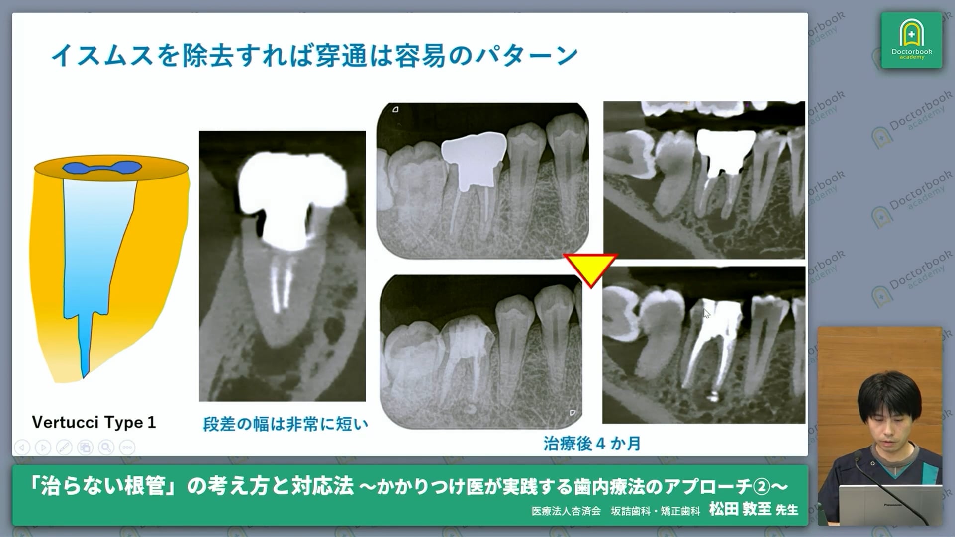 未穿通根管を穿通させる必要があるか？