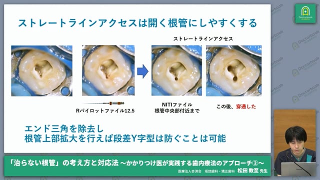 開かない根管